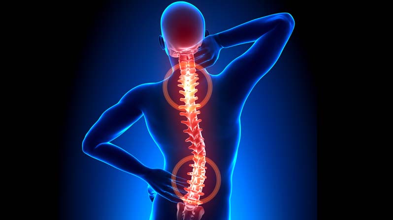 Immagine stilizzata di un uomo con evidenziate le curve della colonna vertebrale affetta da scoliosi