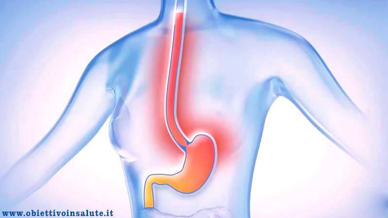 Immagine raffigurante lo stomaco e l'esofago all'interno del corpo umano