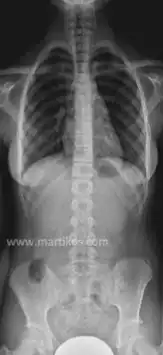 Radiografia di soggetto con colonna vertebrale normale