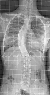 Radiografia di una colonna vertebrale pre intervento chirurgico