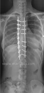 Radiografia di una colonna vertebrale post intervento chirurgico