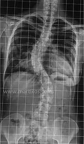 Radiografia di una colonna vertebrale storta, pre intervento chirurgico
