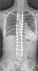 Radiografia di una colonna vertebrale raddrizzata con evidenza dei supporti introdotti con l'intervento chirurgico