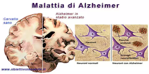 immagine in cui vengono affiancati due cervelli, uno sano e l'altro con l'alzheimer. Il secondo appare più atrofizzato e con delle placche amiloidi