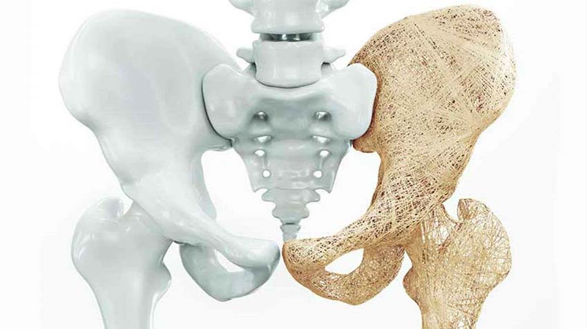 Sezione delle ossa del bacino che mostra una parte sa e l'altra affetta da osteoporosi