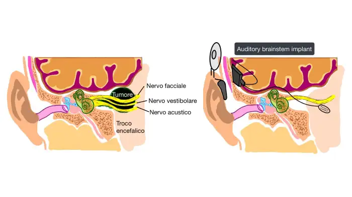 Immagine che mostra una doppia sezione del cervello e delle orecchie. Nella prima viene raffigurato il tumore asportato, nella seconda viene mostrato come è stato posizionato l'impianto descritto nell'articolo