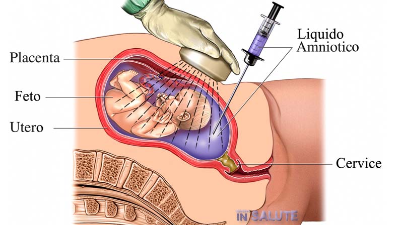 Immagine che raffigura come si esegue l'amniocentesi